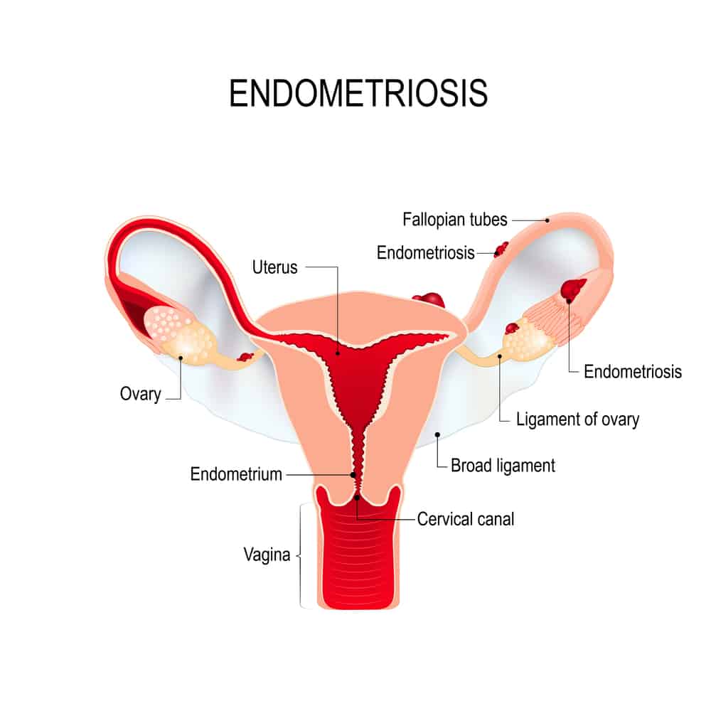How To Treat Endometriosis With Cannabis